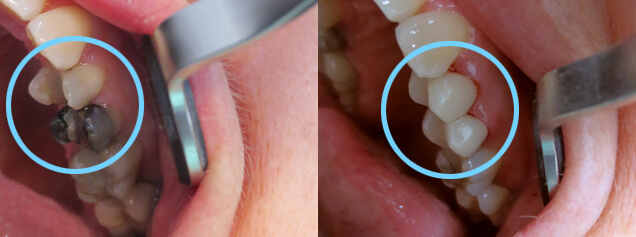 Porcelain Crowns