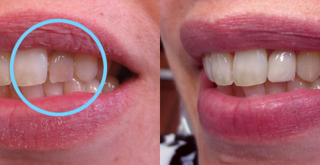 Discolored tooth due to root canal