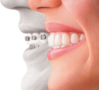 Invisalign Sparta NJ