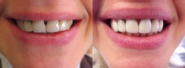 Smile Makeover