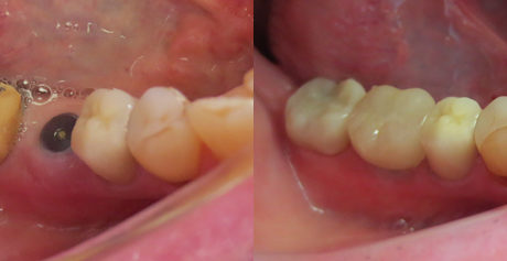 Missing tooth implant crown