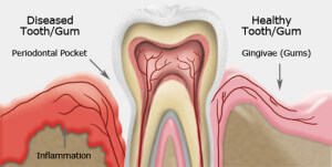 Periodontal Disease