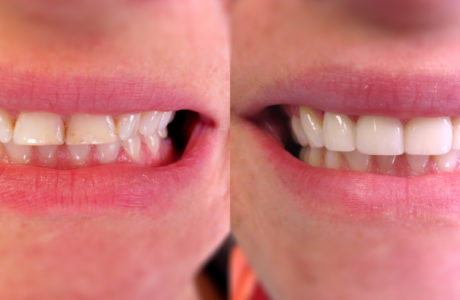 Porcelain veneers