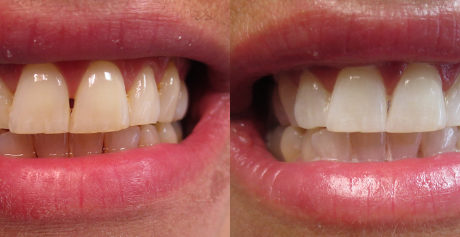 Sparta NJ teeth whitening