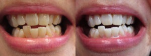 Zoom teeth whitening in Sparta, NJ