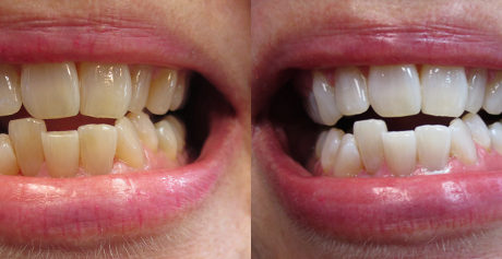 Zoom teeth whitening in Sparta, NJ